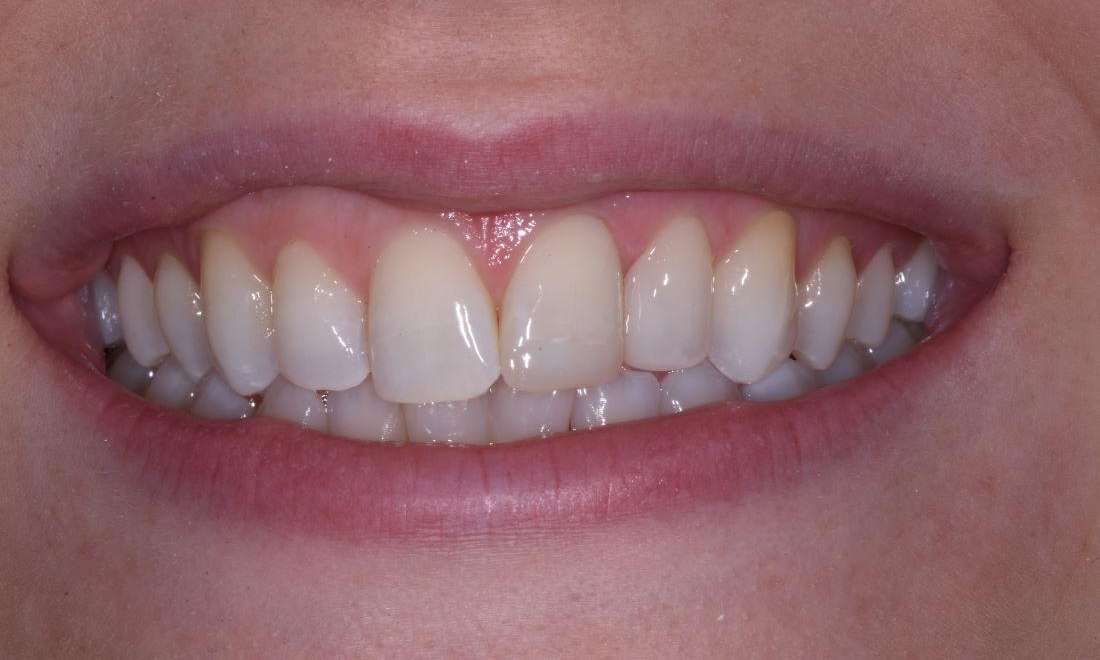 after closing diastema