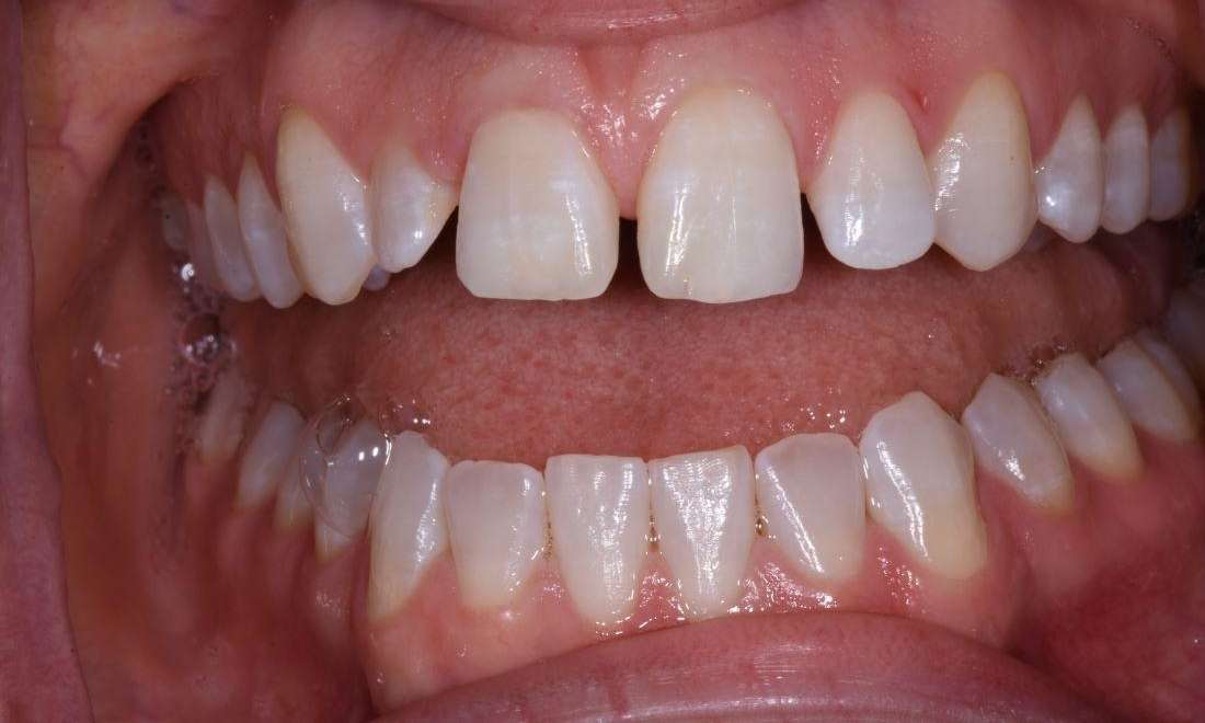 before close diastema spaces