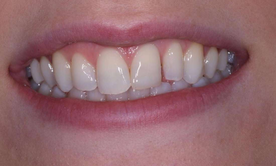 before closing diastema