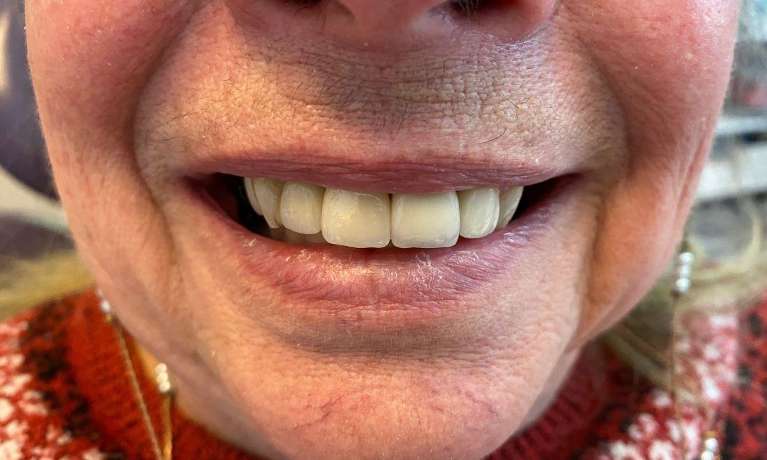 Two-Front-Teeth-Implants-After-Image