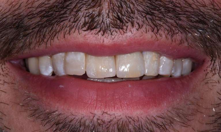 Front-Teeth-Implant-and-Crown-After-Image