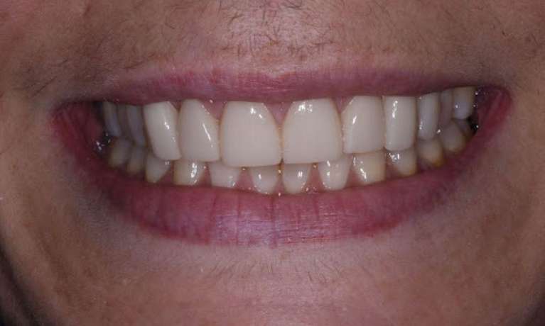 Veneers-After-Image