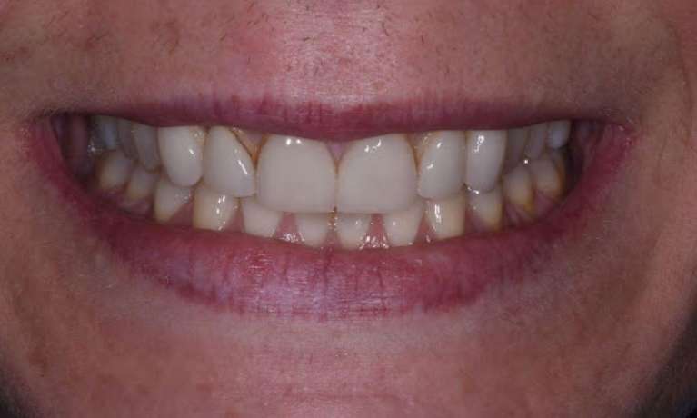 Veneers-Before-Image